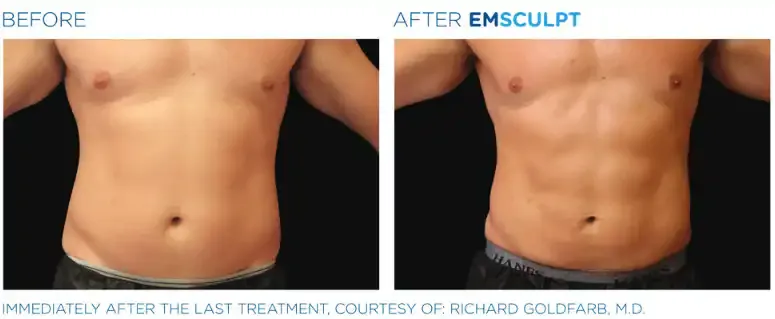 Abdomen before and after Emsculpt NEO treatment.