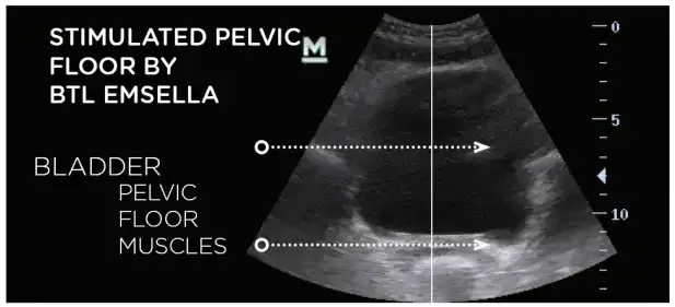 Ultrasound showing a stimulated pelvic floor after BTL Emsella treatment.