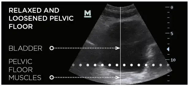 Ultrasound showing a relaxed and loosened pelvic floor before BTL Emsella treatment.
