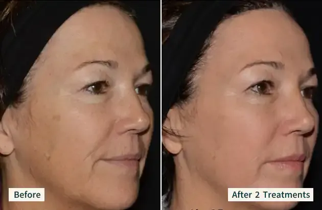 A client's face before treatment and after 2 LaseMD Ultra treatments.