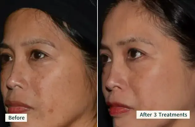 A client's face before treatment and after 3 LaseMD Ultra treatments.