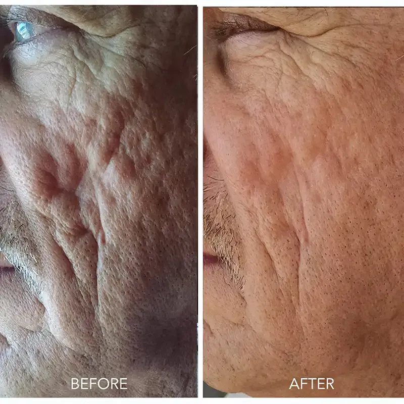 Skin before and after a microneedling treatment.