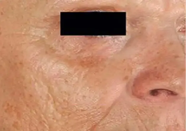 Skin before a PicoSure facial.