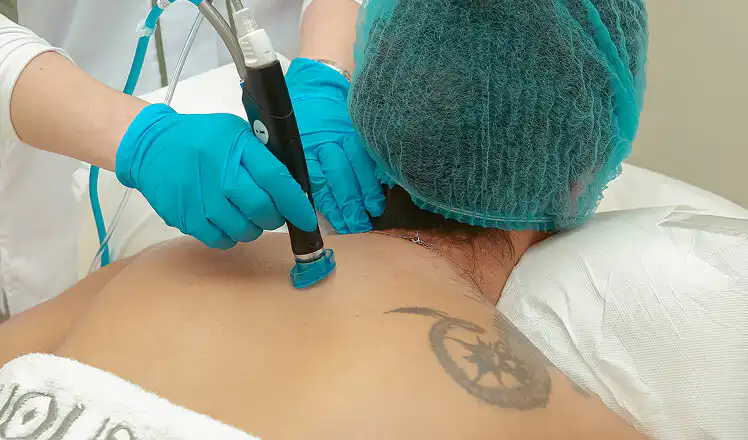 picosure3